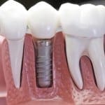 Dental Implants Dallas