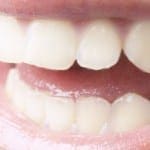 Teeth Whitening Enamel Bleaching