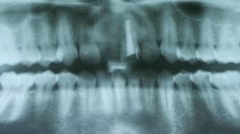 Dental X-Rays