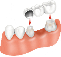 Cost of df of dental Bridges