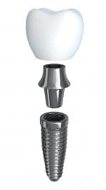 Shown above is the implant, abutment and crown.