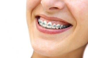 Additional Benefits of braces beyond just a pretty smile. Braces can lead to a much more healthy mouth.